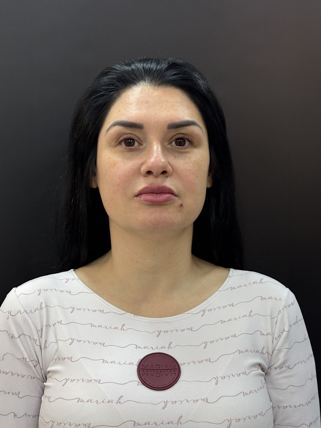 Rosto antes da harmonização facial com preenchimento